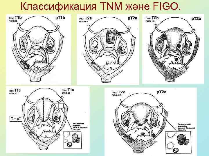 Классификация TNM және FIGO. 