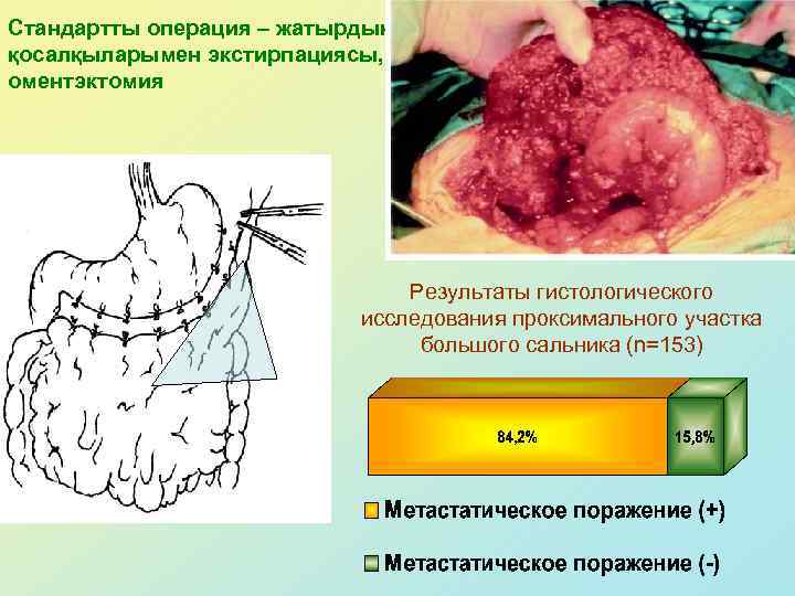 Стандартты операция – жатырдың қосалқыларымен экстирпациясы, оментэктомия Результаты гистологического исследования проксимального участка большого сальника