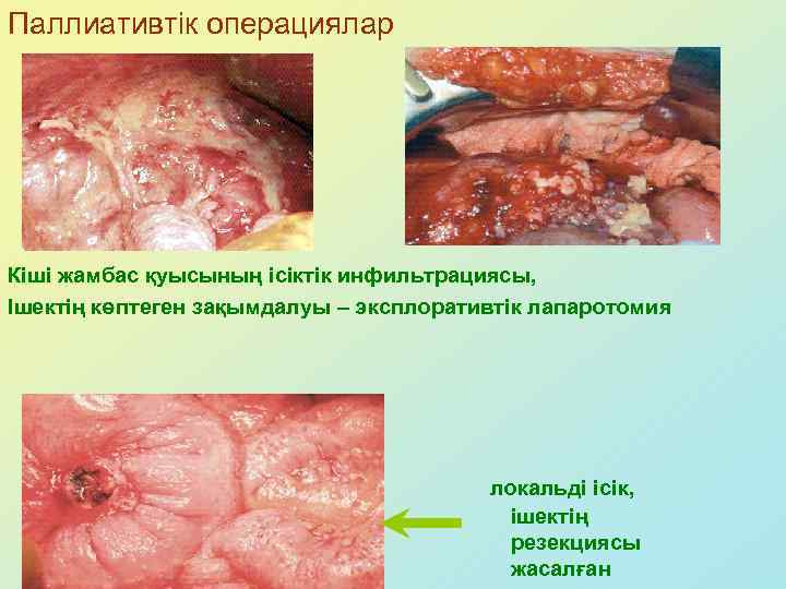 Паллиативтік операциялар Кіші жамбас қуысының ісіктік инфильтрациясы, Ішектің көптеген зақымдалуы – эксплоративтік лапаротомия локальді