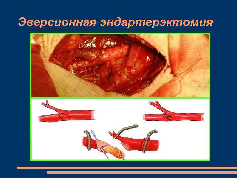 Эверсионная эндартерэктомия 
