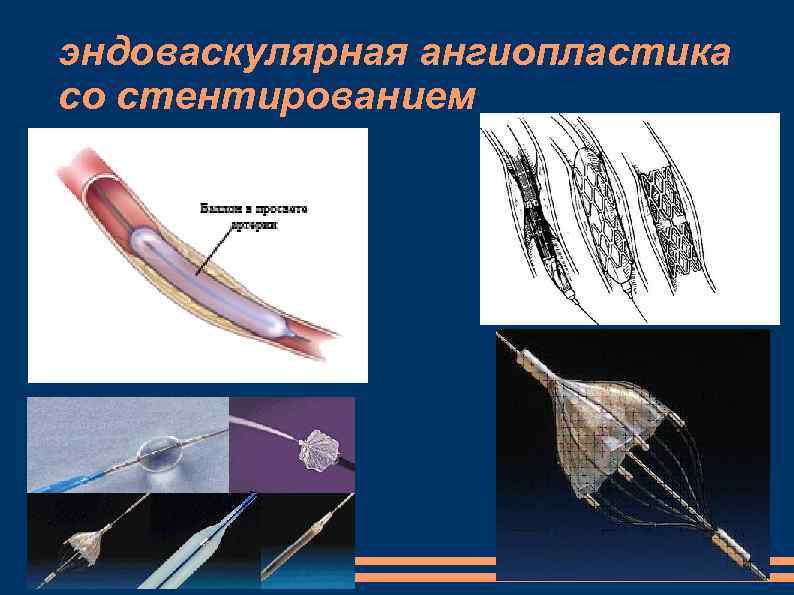 эндоваскулярная ангиопластика со стентированием 