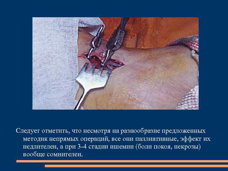 Следует отметить, что несмотря на разнообразие предложенных методик непрямых операций, все они паллиативные, эффект