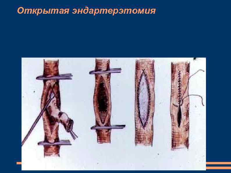 Открытая эндартерэтомия 