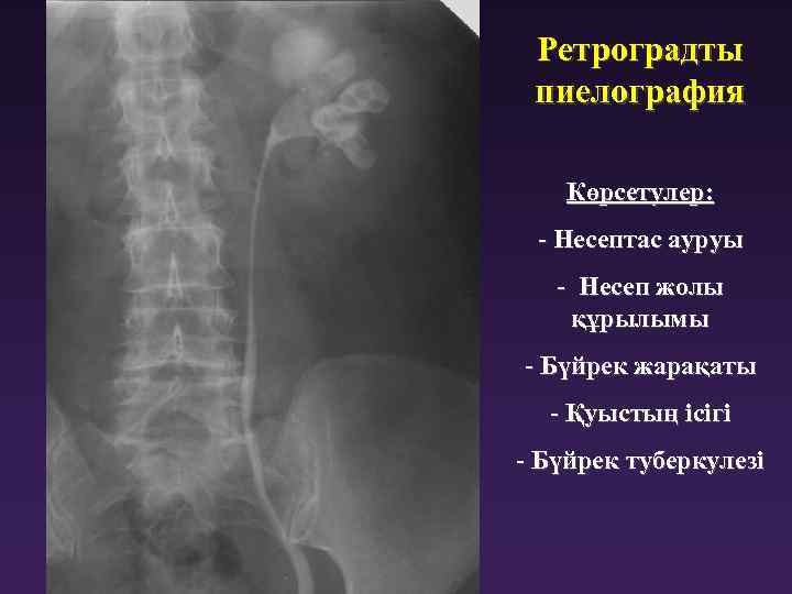 Ретроградты пиелография Көрсетулер: - Несептас ауруы - Несеп жолы құрылымы - Бүйрек жарақаты -