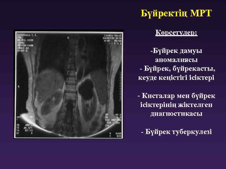 Бүйректің МРТ Көрсетулер: -Бүйрек дамуы аномалиясы - Бүйрек, бүйрекасты, кеуде кеңістігі ісіктері - Кисталар