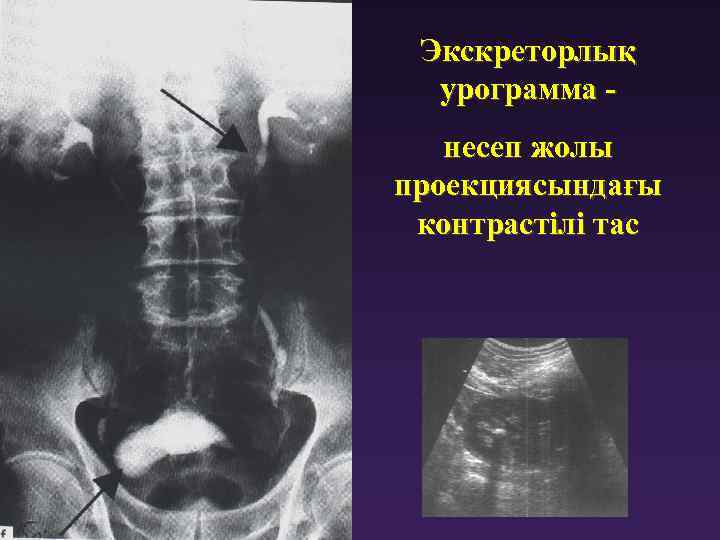 Презентация несеп тас ауруы