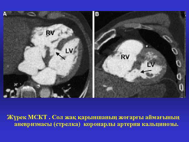 Жүрек МСКТ. Сол жақ қарыншаның жоғарғы аймағының аневризмасы (стрелка) коронарлы артерия кальцинозы. 