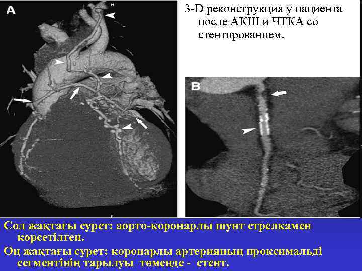 3 -D реконструкция у пациента после АКШ и ЧТКА со стентированием. Сол жақтағы сурет: