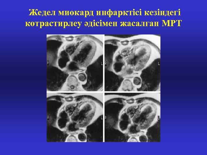 Жедел миокард инфарктісі кезіндегі котрастирлеу әдісімен жасалған МРТ 