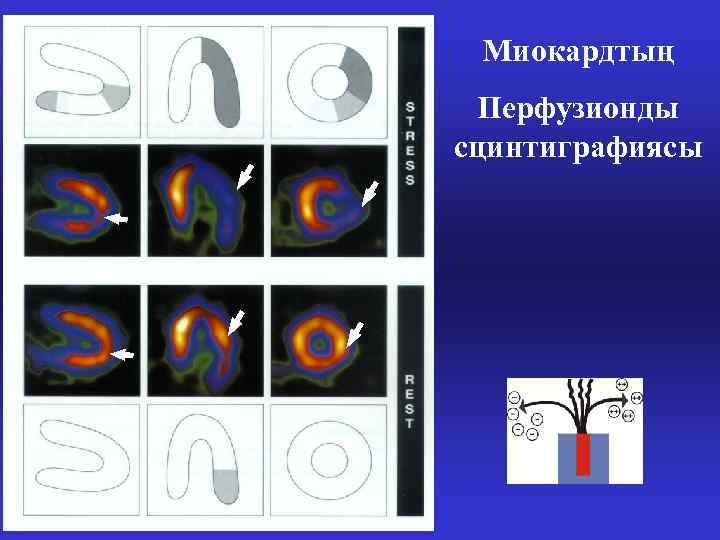 Миокардтың Перфузионды сцинтиграфиясы 