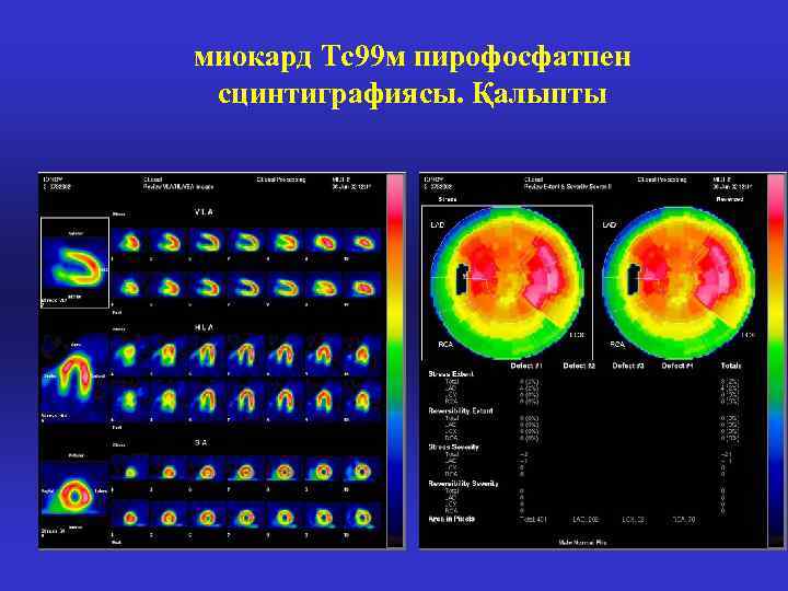 миокард Тс99 м пирофосфатпен сцинтиграфиясы. Қалыпты 