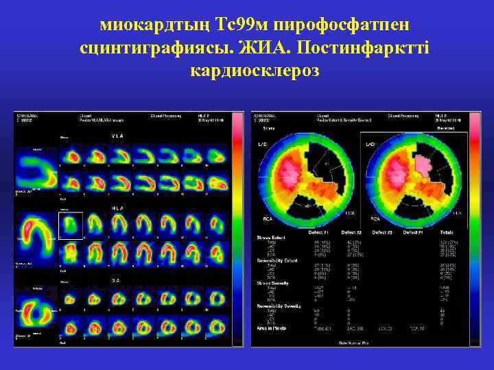 миокардтың Тс99 м пирофосфатпен сцинтиграфиясы. ЖИА. Постинфарктті кардиосклероз 