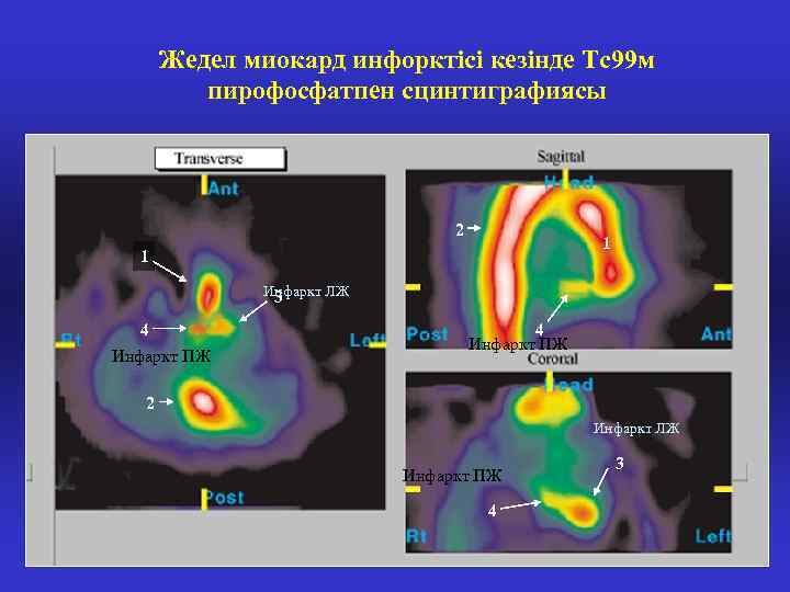 Жедел миокард инфорктісі кезінде Тс99 м пирофосфатпен сцинтиграфиясы 2 1 1 Инфаркт ЛЖ 3