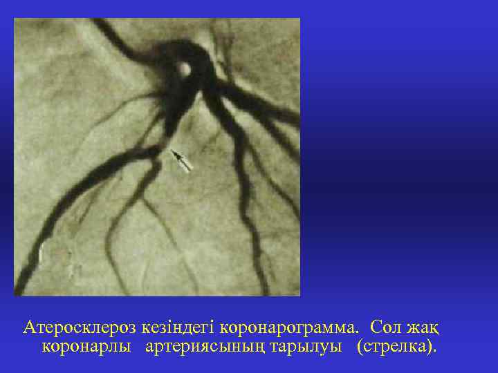 Атеросклероз кезіндегі коронарограмма. Сол жақ коронарлы артериясының тарылуы (стрелка). 