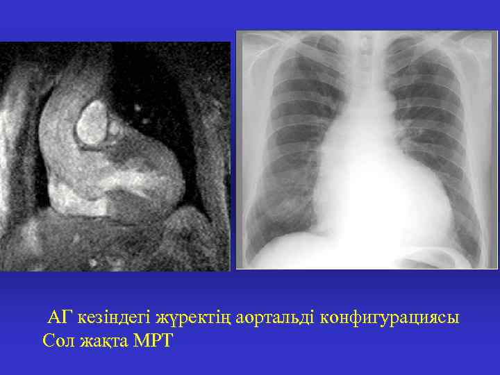 АГ кезіндегі жүректің аортальді конфигурациясы Сол жақта МРТ 