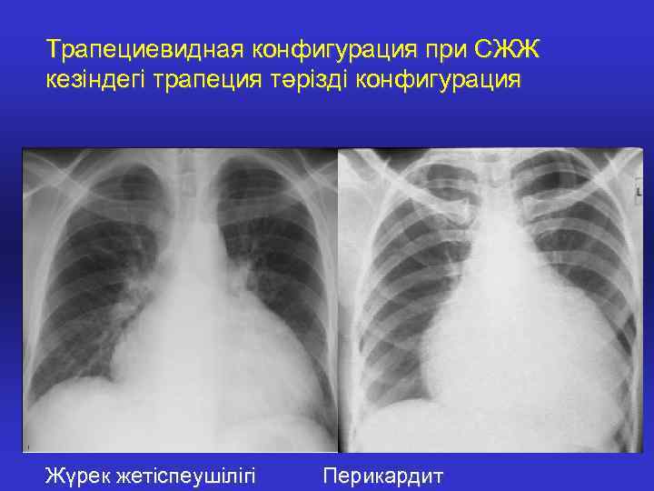 Трапециевидная конфигурация при СЖЖ кезіндегі трапеция тәрізді конфигурация Жүрек жетіспеушілігі Перикардит 