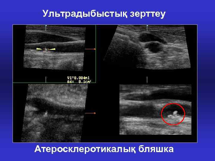 Ультрадыбыстық зерттеу Атеросклеротикалық бляшка 