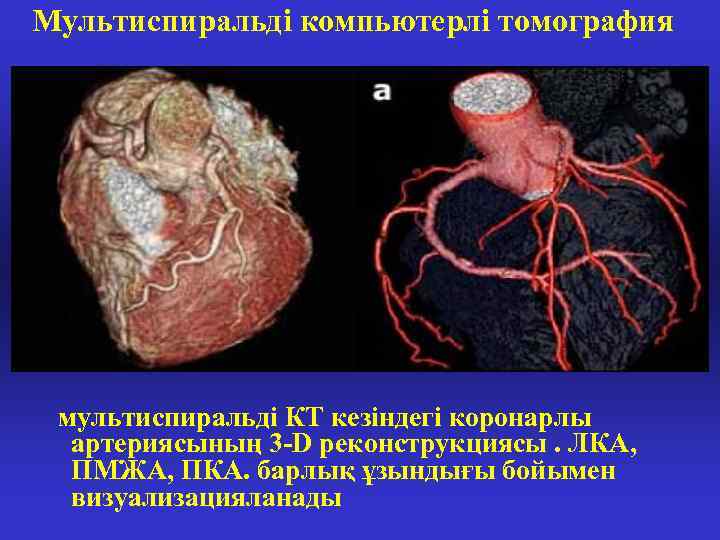 Мультиспиральді компьютерлі томография мультиспиральді КТ кезіндегі коронарлы артериясының 3 -D реконструкциясы. ЛКА, ПМЖА, ПКА.