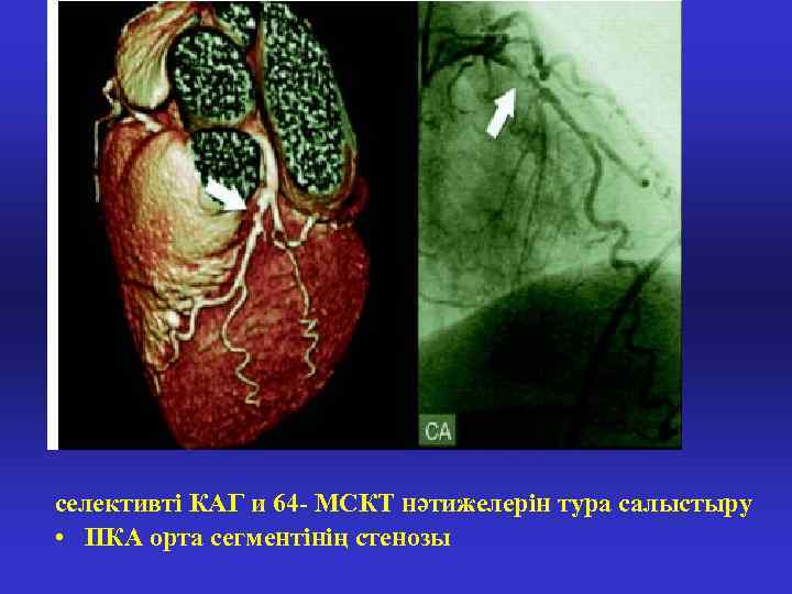 селективті КАГ и 64 - МСКТ нәтижелерін тура салыстыру • ПКА орта сегментінің стенозы