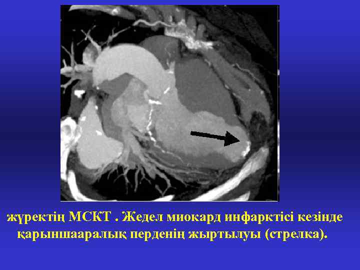 жүректің МСКТ. Жедел миокард инфарктісі кезінде қарыншааралық перденің жыртылуы (стрелка). 