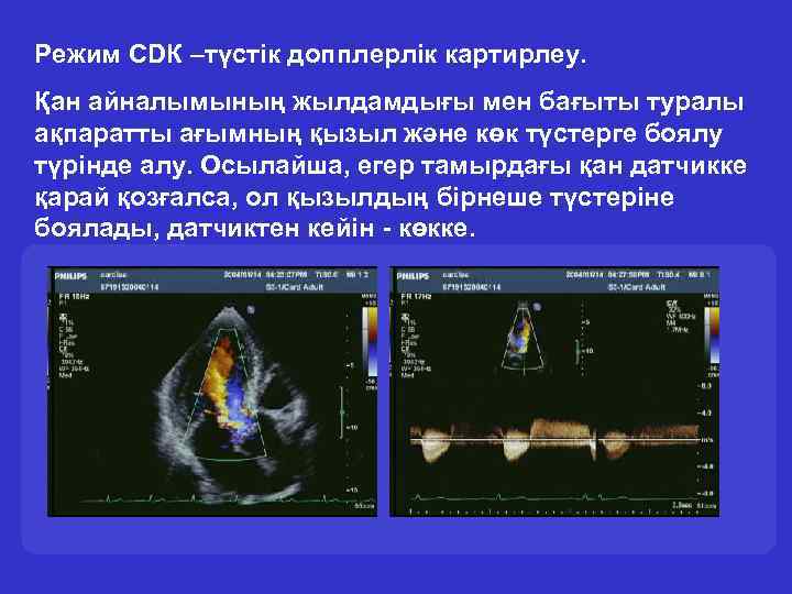 Режим CDК –түстік допплерлік картирлеу. Қан айналымының жылдамдығы мен бағыты туралы ақпаратты ағымның қызыл