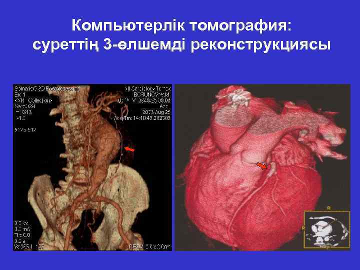 Компьютерлік томография: суреттің 3 -өлшемді реконструкциясы 