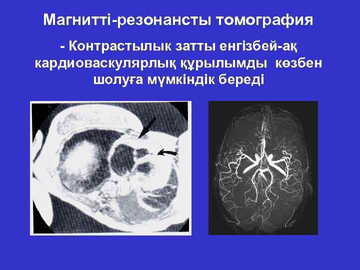Магнитті-резонансты томография - Контрастылык затты енгізбей-ақ кардиоваскулярлық құрылымды көзбен шолуға мүмкіндік береді 