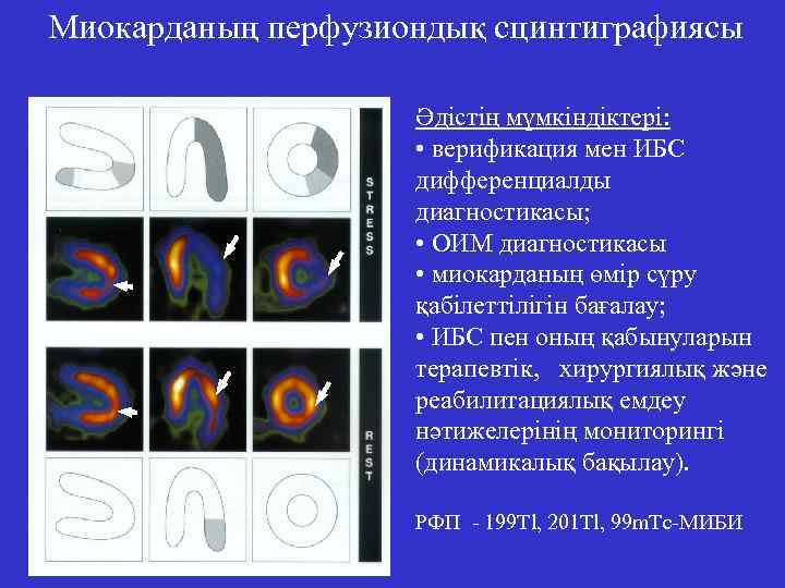 Миокарданың перфузиондық сцинтиграфиясы Әдістің мүмкіндіктері: • верификация мен ИБС дифференциалды диагностикасы; • ОИМ диагностикасы