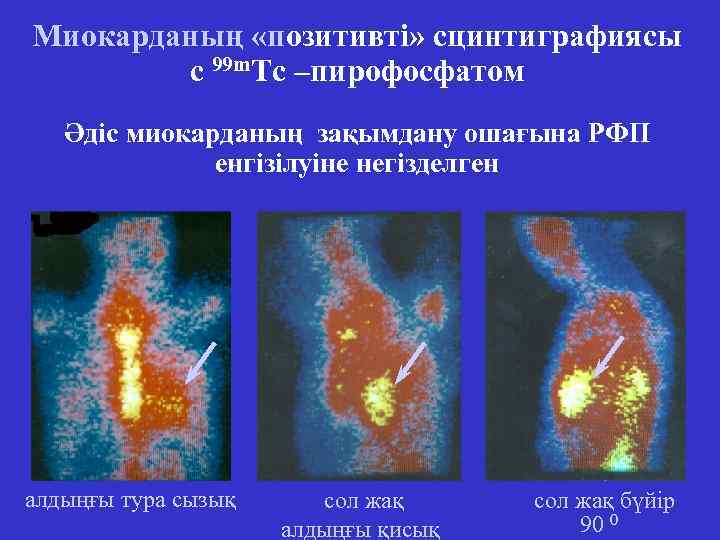 Миокарданың «позитивті» сцинтиграфиясы с 99 m. Tc –пирофосфатом Әдіс миокарданың зақымдану ошағына РФП енгізілуіне