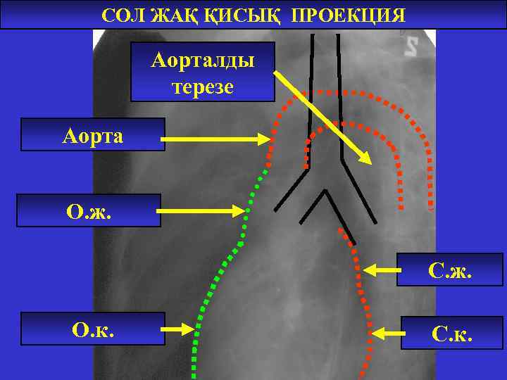 СОЛ ЖАҚ ҚИСЫҚ ПРОЕКЦИЯ Аорталды терезе Аорта О. ж. С. ж. О. к. С.