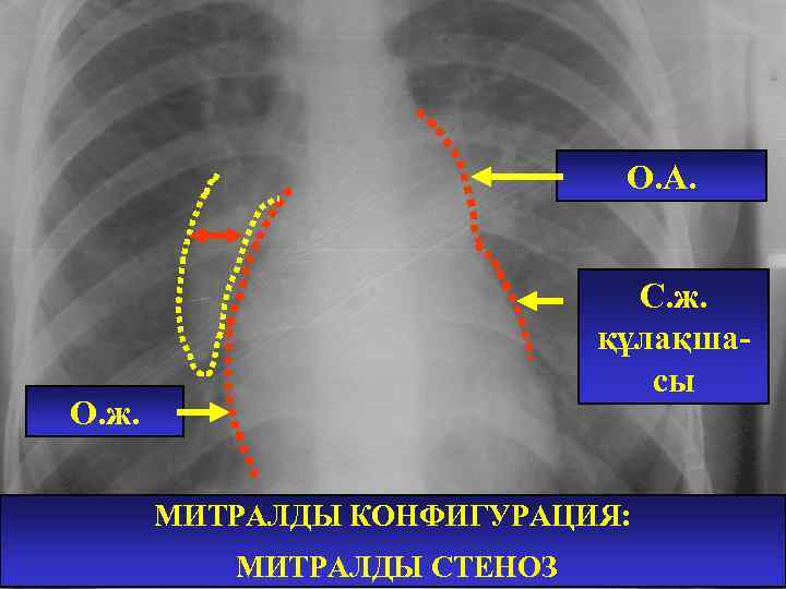 Митральды қақпақша жетіспеушілігі презентация