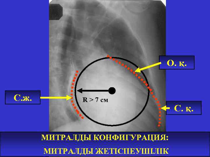 О. қ. С. ж. R > 7 см МИТРАЛДЫ КОНФИГУРАЦИЯ: МИТРАЛДЫ ЖЕТІСПЕУШІЛІК С. қ.