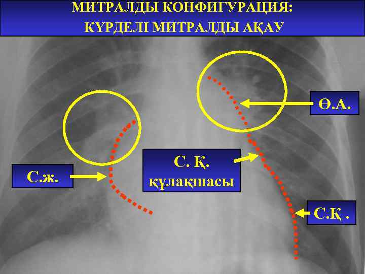МИТРАЛДЫ КОНФИГУРАЦИЯ: КҮРДЕЛІ МИТРАЛДЫ АҚАУ Ө. А. С. ж. С. Қ. құлақшасы С. Қ.
