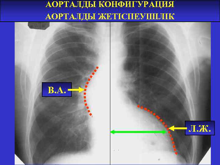 АОРТАЛДЫ КОНФИГУРАЦИЯ АОРТАЛДЫ ЖЕТІСПЕУШІЛІК В. А. Л. Ж. 