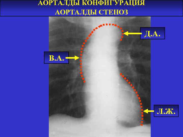АОРТАЛДЫ КОНФИГУРАЦИЯ АОРТАЛДЫ СТЕНОЗ Д. А. В. А. Л. Ж. 