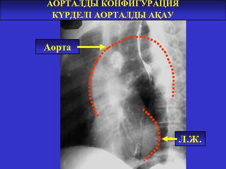 АОРТАЛДЫ КОНФИГУРАЦИЯ КҮРДЕЛІ АОРТАЛДЫ АҚАУ Аорта Л. Ж. 