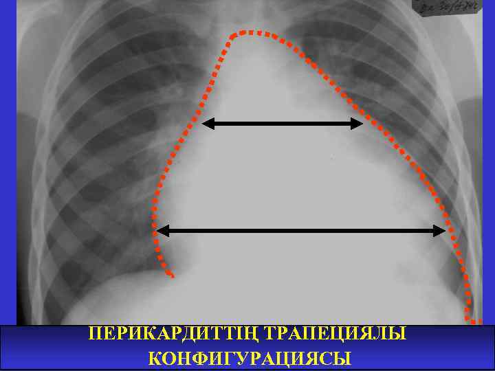 ПЕРИКАРДИТТІҢ ТРАПЕЦИЯЛЫ КОНФИГУРАЦИЯСЫ 