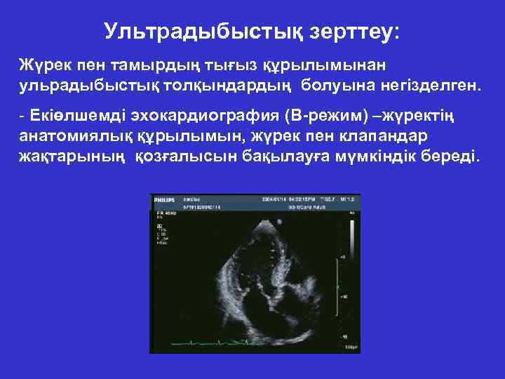 Ультрадыбыстық зерттеу: Жүрек пен тамырдың тығыз құрылымынан ульрадыбыстық толқындардың болуына негізделген. - Екіөлшемді эхокардиография