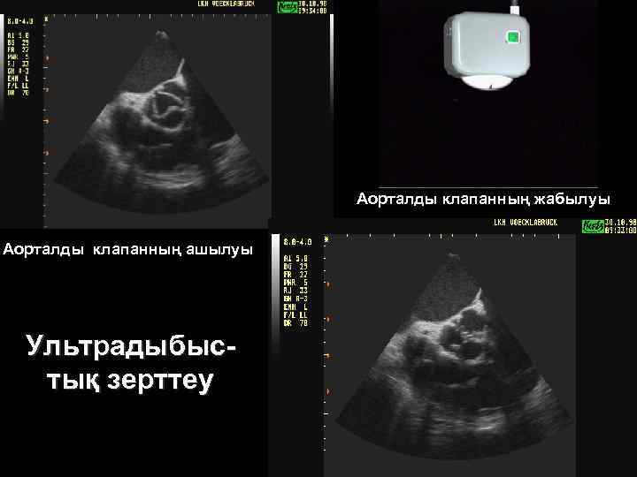 Аорталды клапанның жабылуы Аорталды клапанның ашылуы Ультрадыбыстық зерттеу 