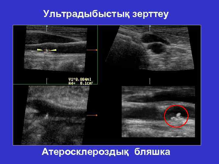 Ультрадыбыстық зерттеу Атеросклероздық бляшка 