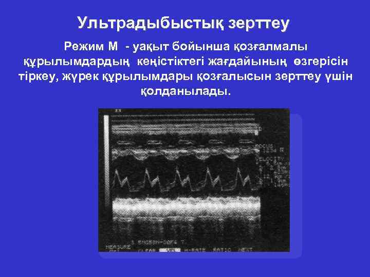 Ультрадыбыстық зерттеу Режим М - уақыт бойынша қозғалмалы құрылымдардың кеңістіктегі жағдайының өзгерісін тіркеу, жүрек