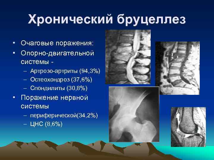 Хронический бруцеллез • Очаговые поражения: • Опорно-двигательной системы – Артрозо-артриты (94, 3%) – Остеохондроз