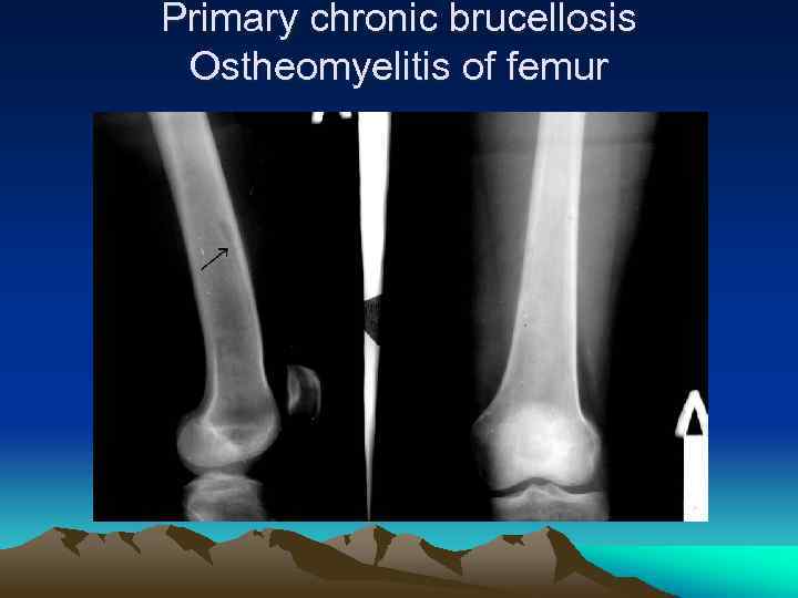 Primary chronic brucellosis Ostheomyelitis of femur 