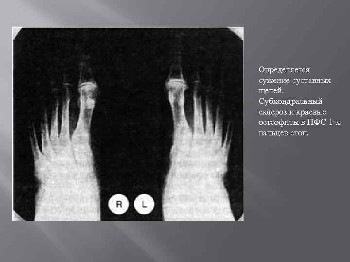 Определяется сужение суставных щелей. Субхондральный склероз и краевые остеофиты в ПФС 1 -х пальцев