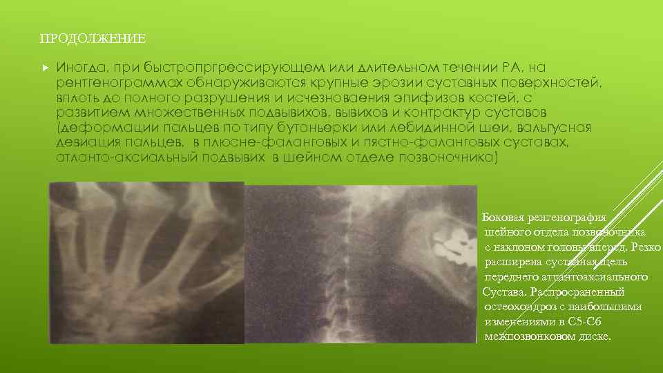 ПРОДОЛЖЕНИЕ Иногда, при быстропргрессирующем или длительном течении РА, на рентгенограммах обнаруживаются крупные эрозии суставных