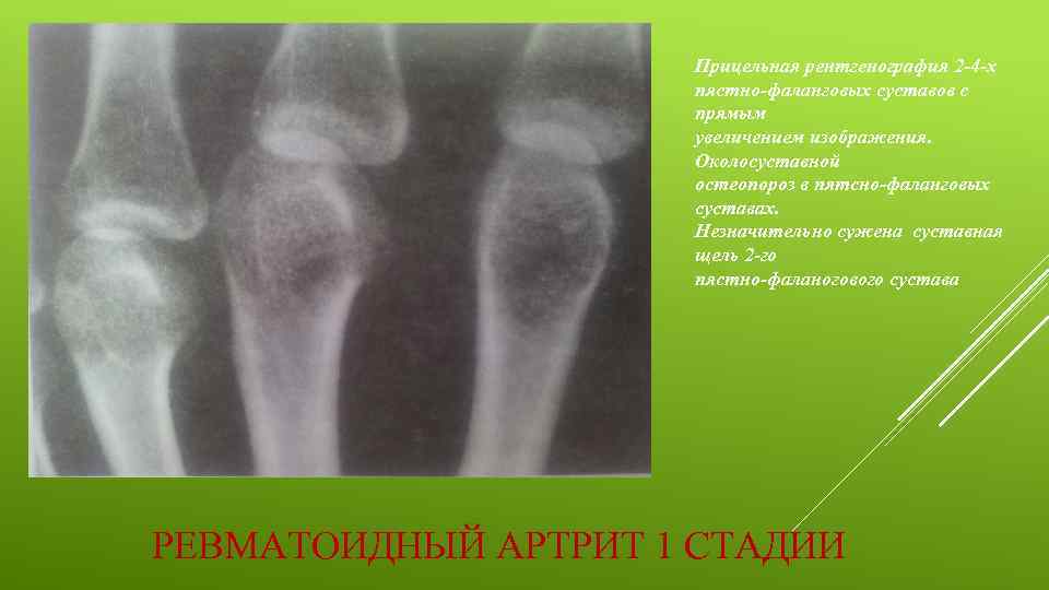 Прицельная рентгенография 2 -4 -х пястно-фаланговых суставов с прямым увеличением изображения. Околосуставной остеопороз в