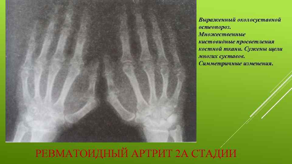 Выраженный околосуставной остеопороз. Множественные кистовидные просветления костной ткани. Сужены щели многих суставов. Симметричные изменения.