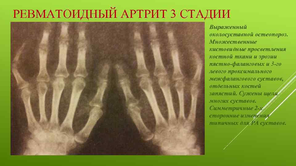 РЕВМАТОИДНЫЙ АРТРИТ 3 СТАДИИ Выраженный околосуставной остеопороз. Множественные кистовидные просветления костной ткани и эрозии