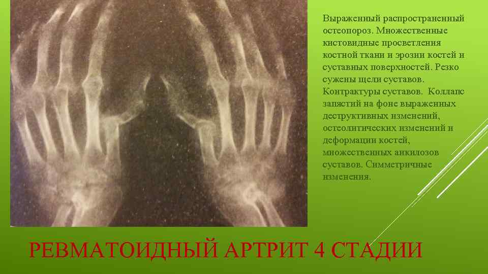 Выраженный распространенный остеопороз. Множественные кистовидные просветления костной ткани и эрозии костей и суставных поверхностей.
