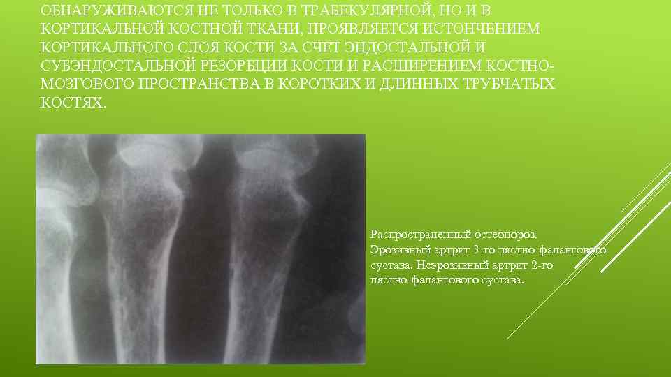 ОБНАРУЖИВАЮТСЯ НЕ ТОЛЬКО В ТРАБЕКУЛЯРНОЙ, НО И В КОРТИКАЛЬНОЙ КОСТНОЙ ТКАНИ, ПРОЯВЛЯЕТСЯ ИСТОНЧЕНИЕМ КОРТИКАЛЬНОГО